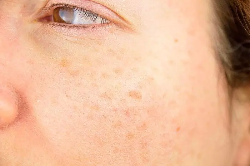 Nám da mặt vùng má với sự xuất hiện của những đốm, mảng nám trên da