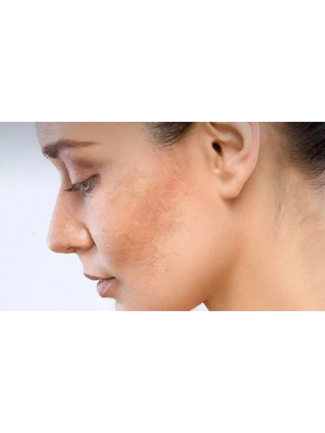  Nám da mặt vùng má: Nguyên nhân và cách điều trị dứt điểm, hiệu quả